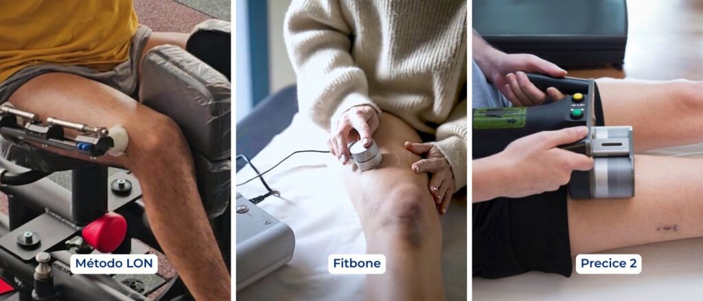 Método LON, Fitbone and Precice 2. Los métodos modernos de alargamiento óseo reducen los riesgos y mejoran la comodidad del paciente.