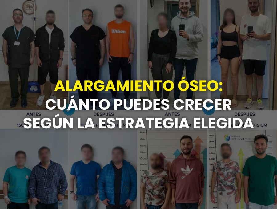 Alargamiento óseo cuánto puedes crecer según la estrategia elegida