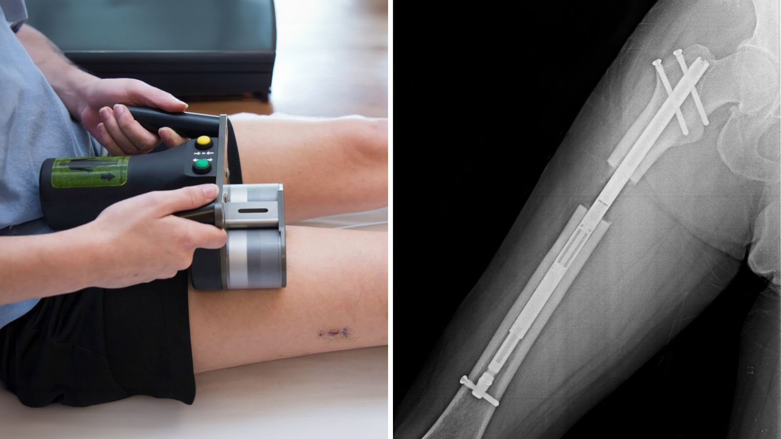 Alargamiento de fémur - radiografía