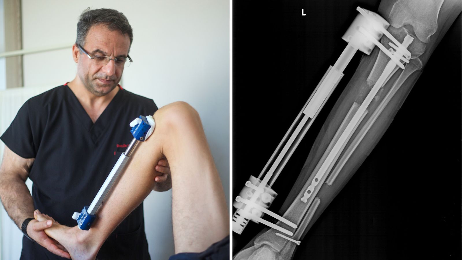 alargamiento de tibia con el método LON