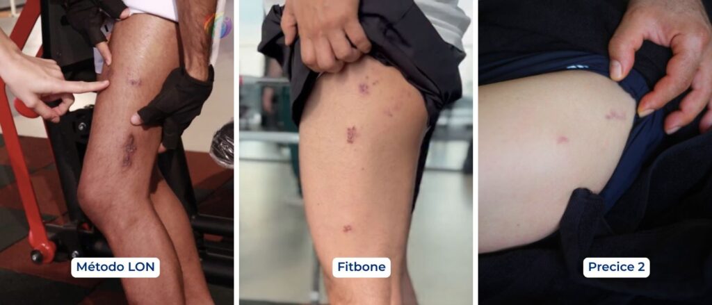 Cicatrices reales de alargamiento de piernas con tres métodos: LON (izquierda), Fitbone (centro) y Precice 2 (derecha)