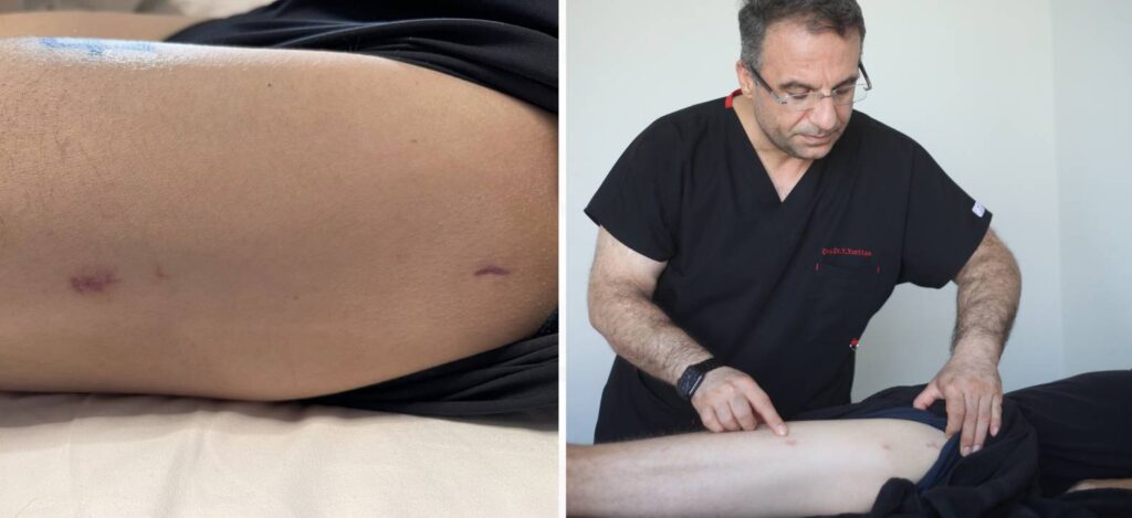 Cicatrices de Precice 2 al mes y a los 9 meses: evolución real durante revisión del Prof. Dr. Yuksel Yurttas