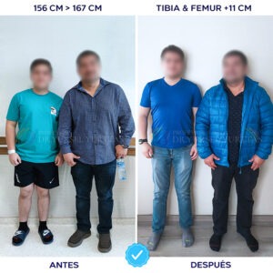 Paciente de Latinoamérica - Antes y Después de Elongación Ósea