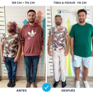 Paciente de Rusia antes y después de dos cirugías de alargamiento de piernas, aumentando su estatura de 159 cm a 174 cm y logrando un crecimiento total de 15 cm con resultados visibles.