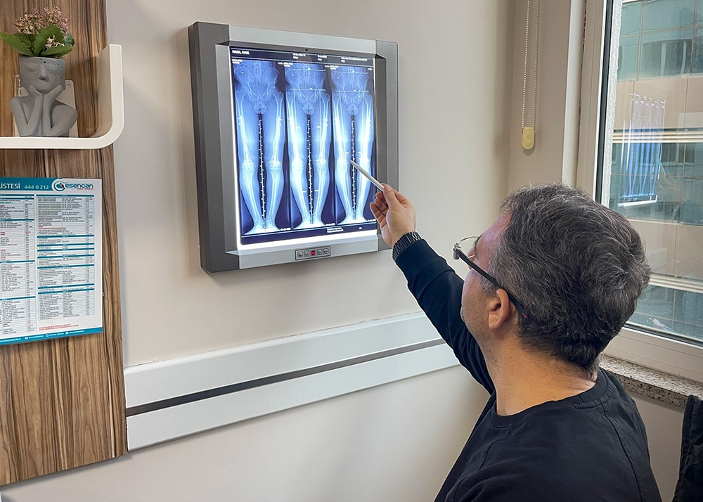 El cirujano evalúa la radiografía de los huesos de las piernas antes de la cirugía de alargamiento de las piernas.