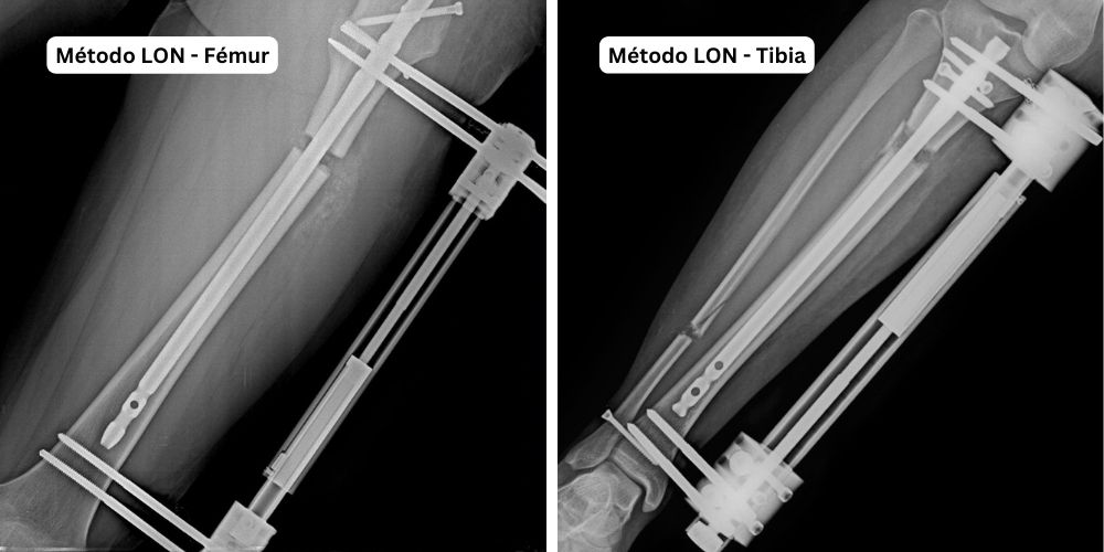 Representación del método LON de elongación ósea aplicado a fémur y tibia visualizado mediante rayos X