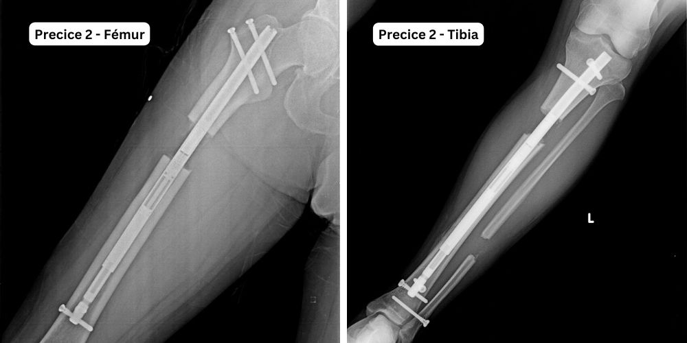 Imagen de rayo X mostrando el clavo intramedular Precice para alargamiento óseo en fémur y tibia.