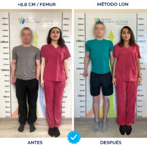 Resultados del método LON para alargamiento de estatura en Turquía. Paciente logra un aumento de 8.8 cm en los fémures con el equipo del Dr. Yuksel Yurttas.
