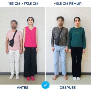 Antes y después de cirugía de alargamiento de piernas fémur, paciente aumentó 10.5 cm