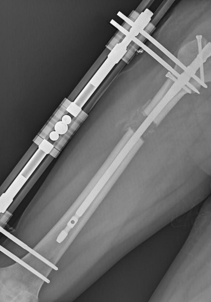 alargamiento del fémur