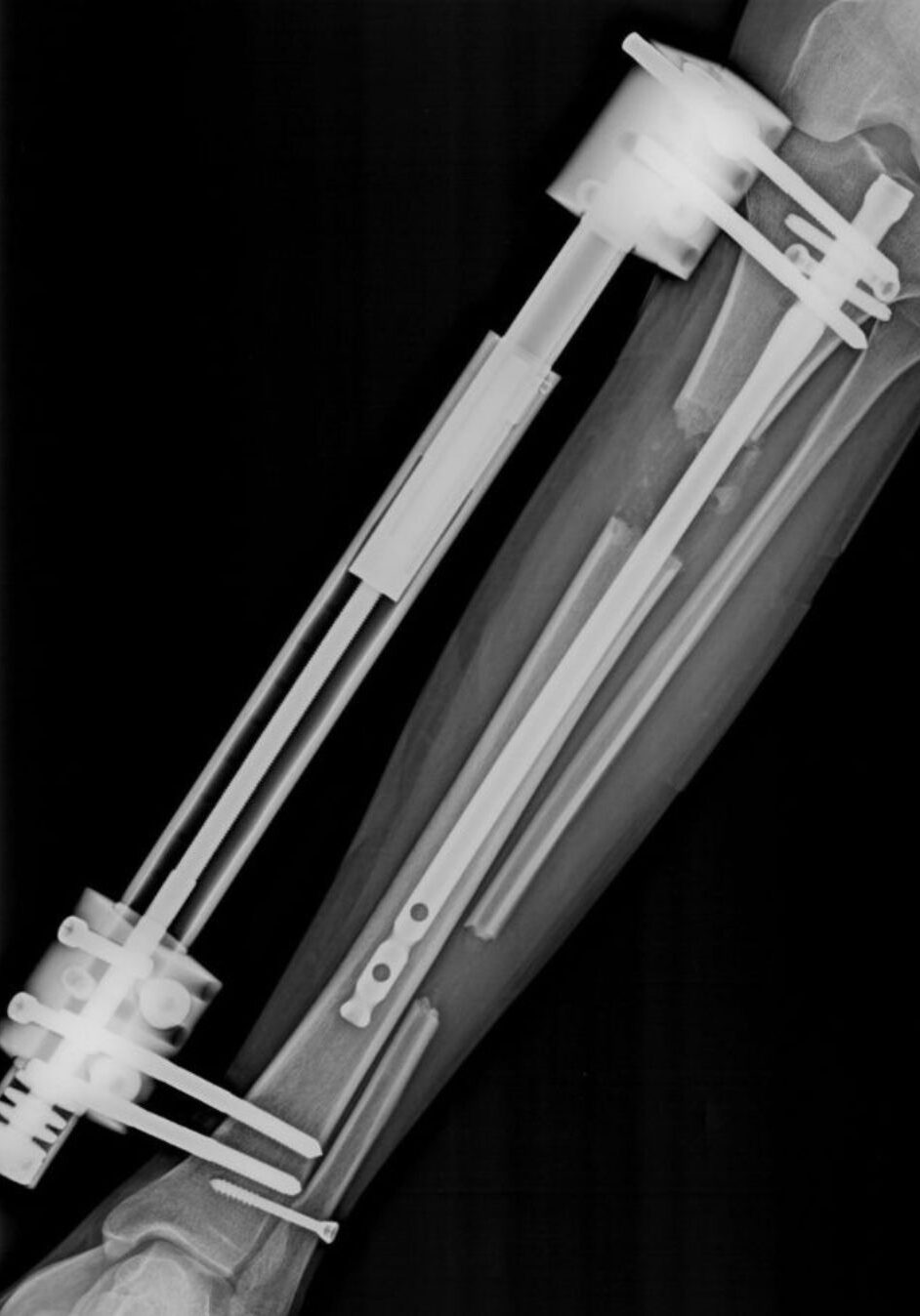 cirugía de alargamiento de tibia